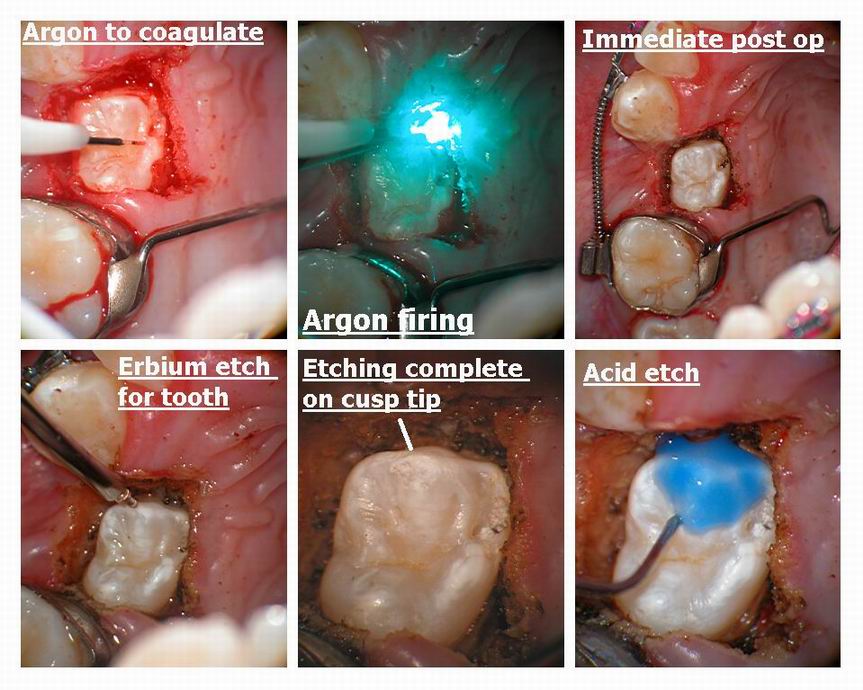 Resize of Exposure of premolar pg 2.jpg